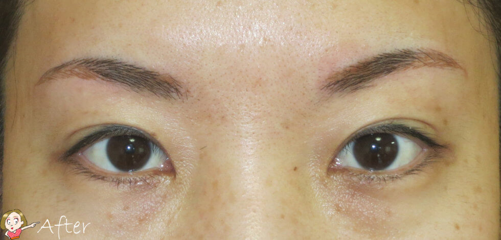 消えない眉_施術後