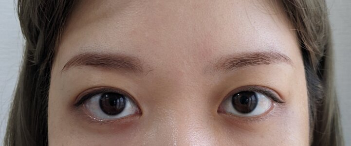 「左右対称の眉デザインを目指した施術結果」